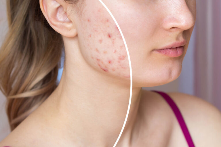 Best Skincare for Hormonal Acne (PCOS-Friendly Picks)