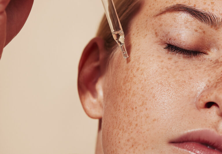 Why PCOS Acne Is Different (And Why Typical Acne Advice Often Fails)