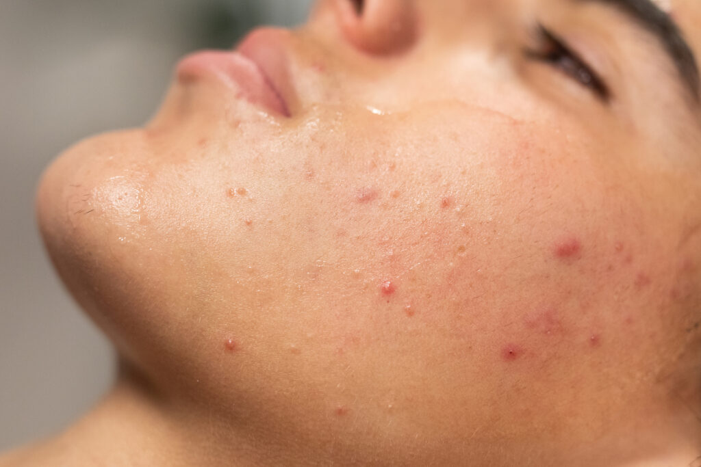 hormonal acne on chin and jawline PCOS