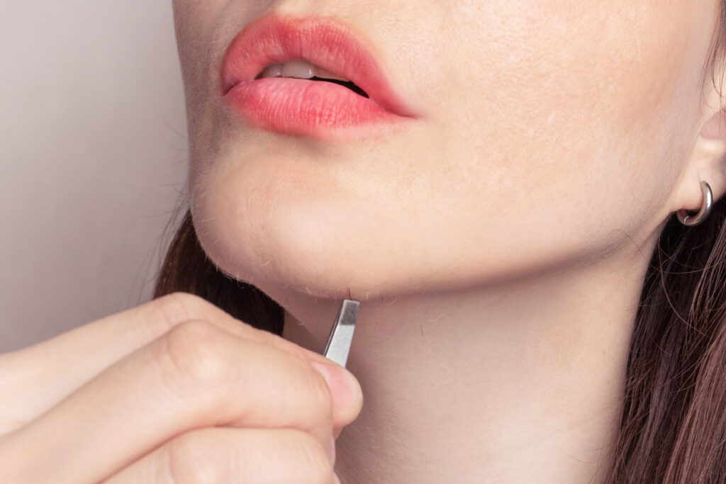  PCOS chin hair frustration and emotional impact
